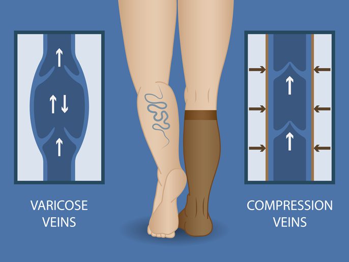Compression Therapy - Premier Vascular and Vein Center